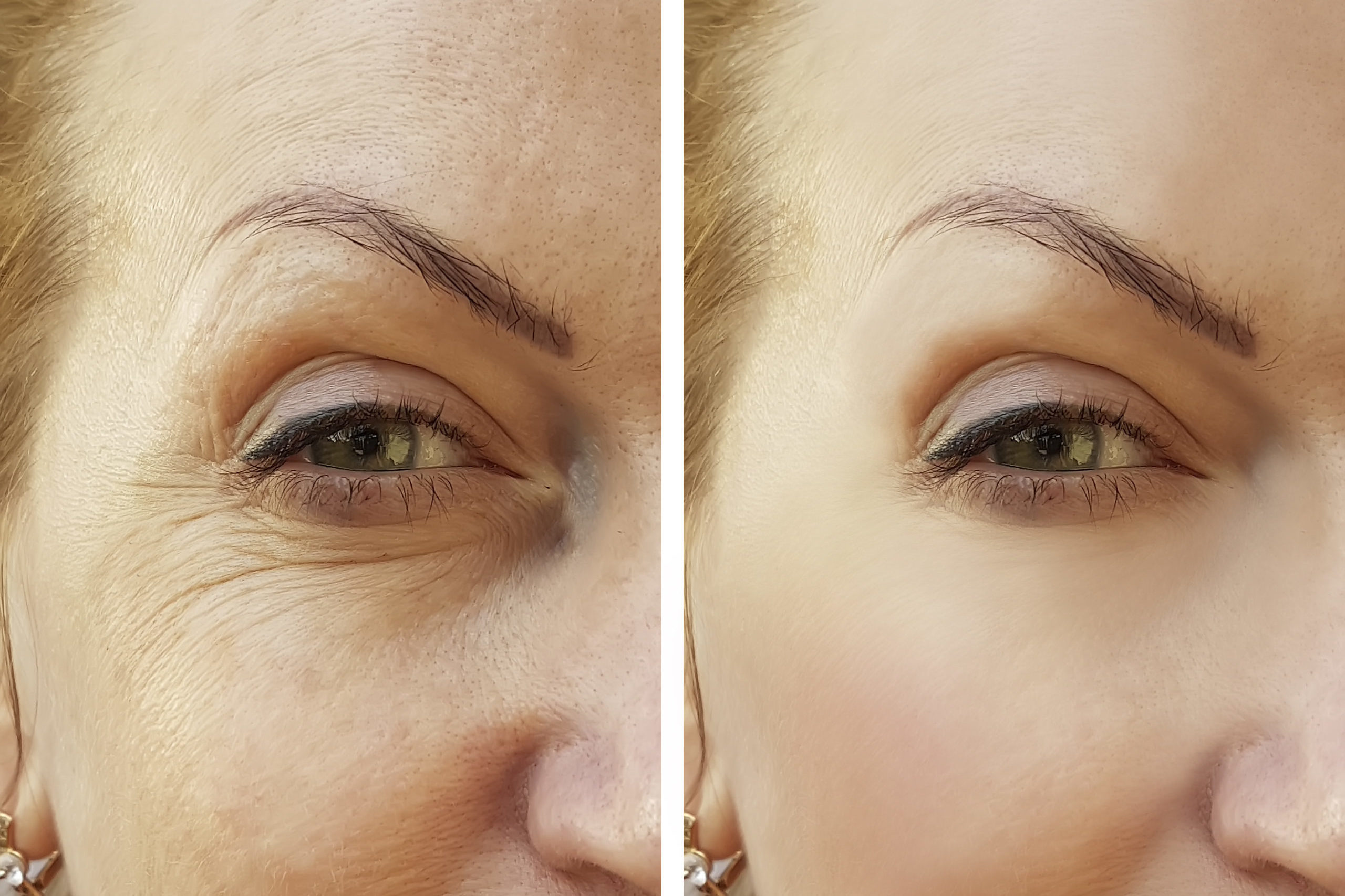 woman face wrinkles before and after procedures