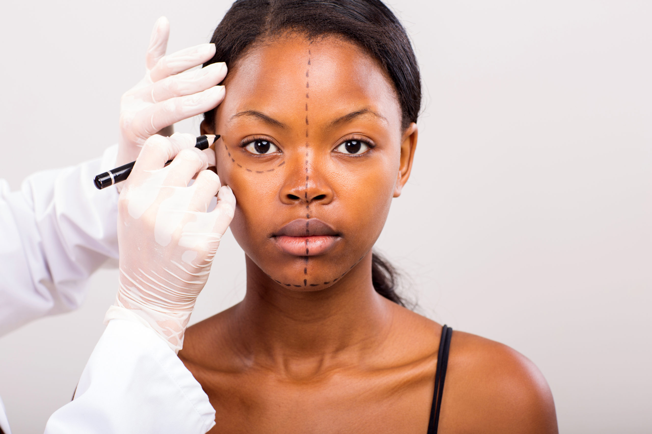 cosmetic surgeon drawing lines on african girl face for plastic surgery